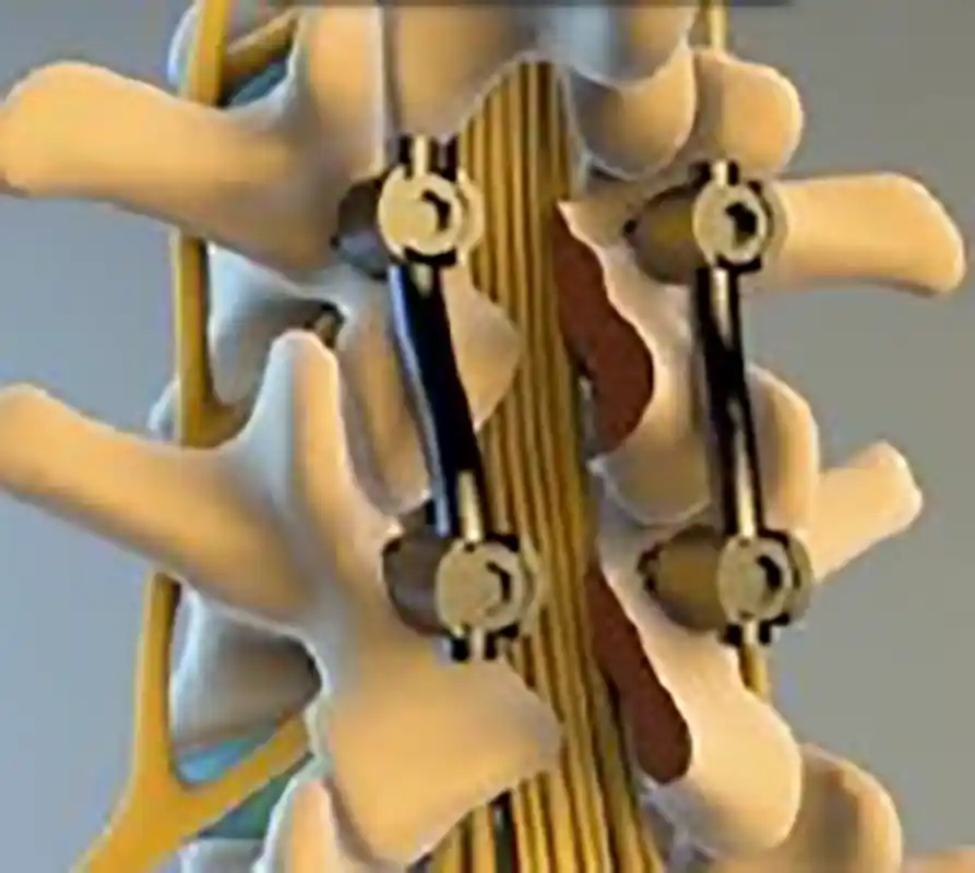 Spinal Fusion