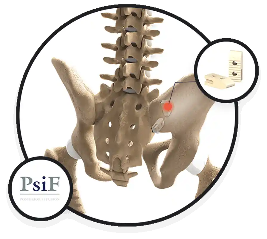 Posterior SI Fusion